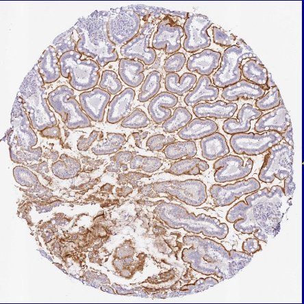 IHC-stained TMA core