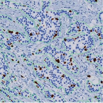 Digital pathology image analysis on an IHC core